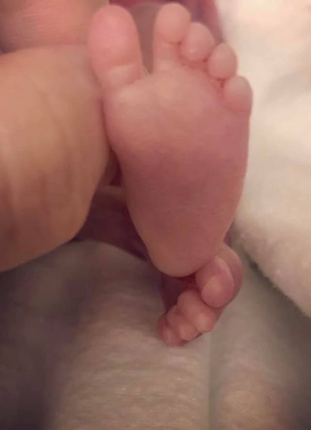 Photo courtesy of Jessica Spradlin (Kailor, born at 22 weeks, four days) Photo courtesy of Jessica Spradlin (Kailor, born at 22 weeks, four days)
