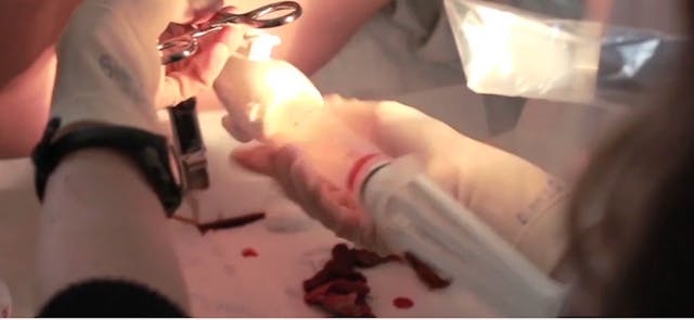 Early Pregnancy Uterine Aspiration with MUA Image: Early Pregnancy Uterine Aspiration with MUA