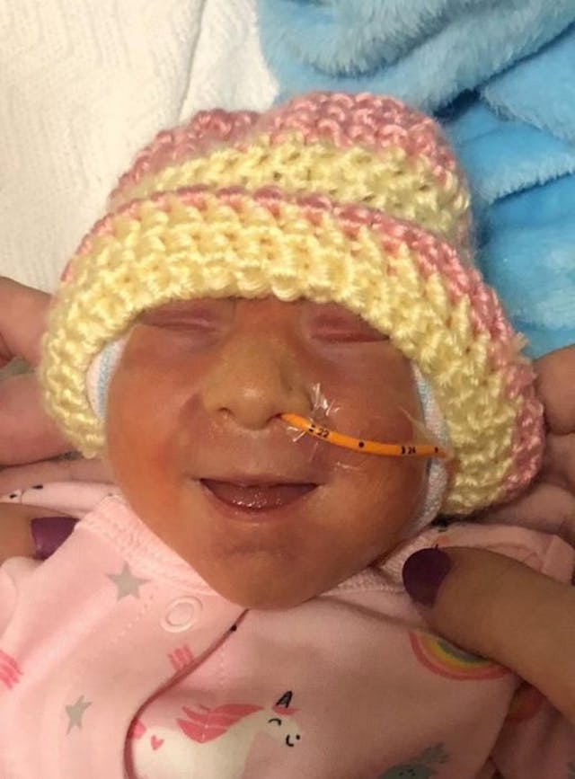 Railyn Hope (via WV Gazette obituary) anencephaly