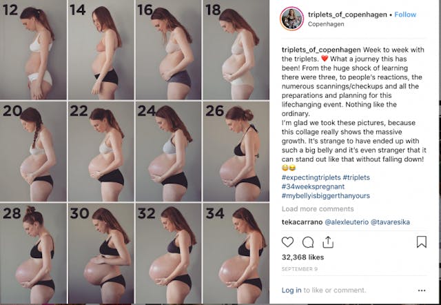 Parents of triplets: Doctor wanted us to have selective reduction abortion image