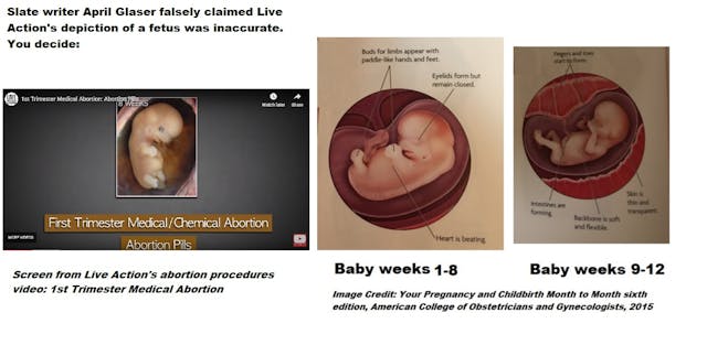 Image: Live Action abortion procedure vid v ACOG 1st trimester fetal development