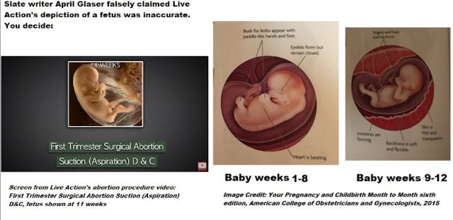 Image: Live Action aspiration abortion procedures video first trimester fetal image V ACOG