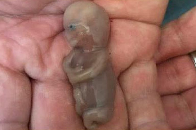 miscarried, miscarriage