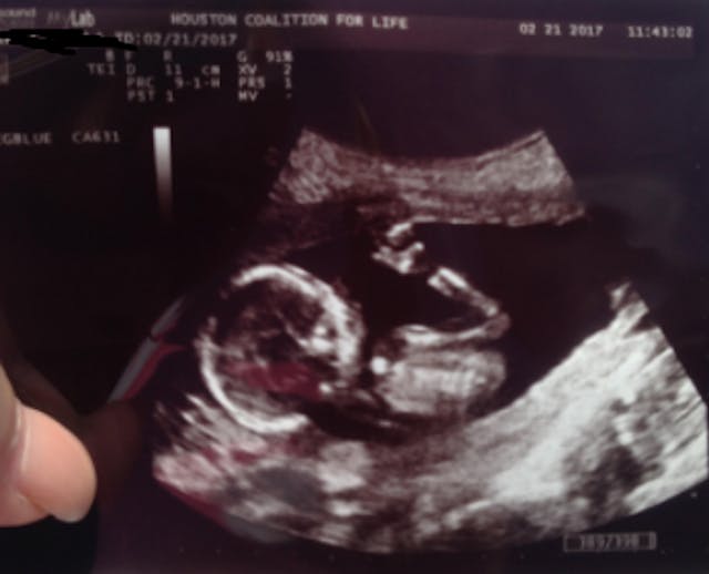 Mobile ultrasound unit sonogram of baby abortion, Planned Parenthood