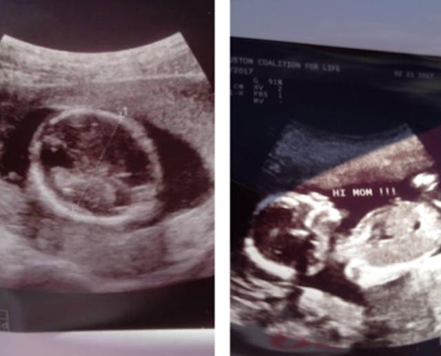 Two ultrasounds of the same baby, side by side (L: Planned Parenthood; R: mobile ultrasound unit) abortion, Planned Parenthood