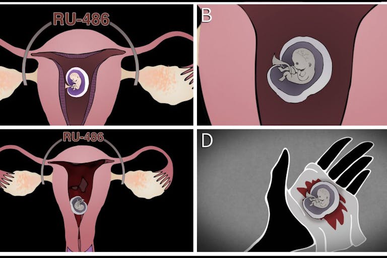 medical-abortion-diagram-4-quadrant-labels