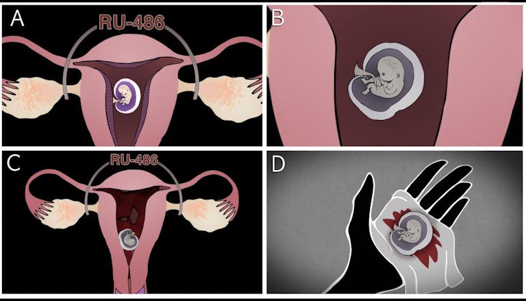 medical-abortion-diagram-4-quadrant-labels