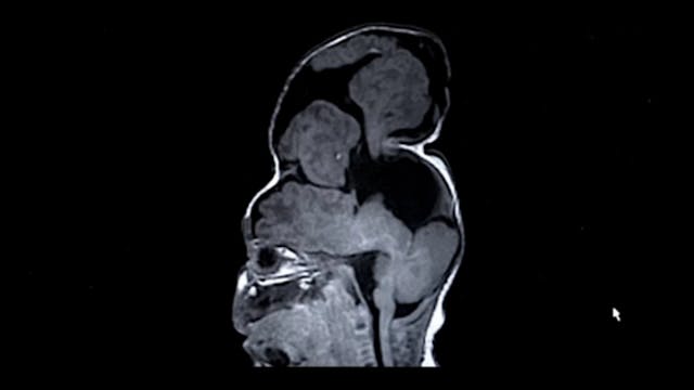 Imaging of Bentley’s head from Boston Children’s Hospital video. Imaging of Bentley's head from Boston Children's Hospital video.