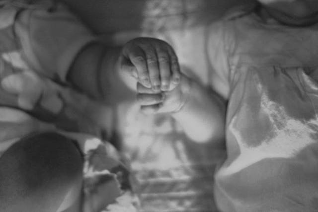 Shelley's twins, twin to twin transfusion, permission granted for this article