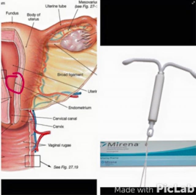 Mirena IUD