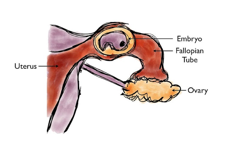 Ectopic_Pregnancy_Diagram