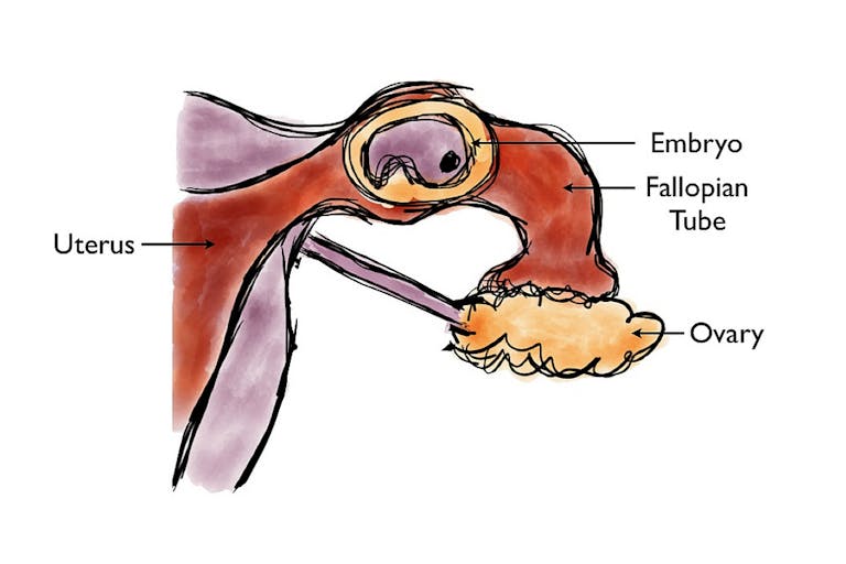 Ectopic_Pregnancy_Diagram