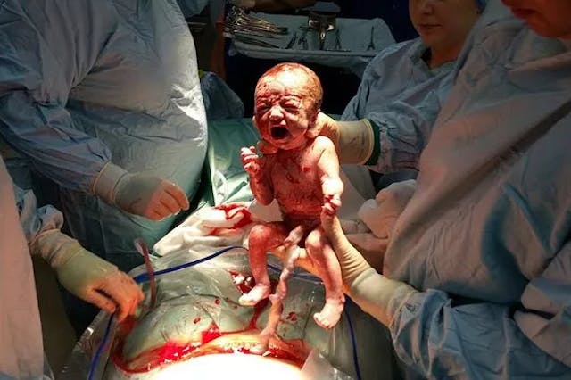 Baby Lennox Caines Emily Caines, who released a picture of baby being born at 24 weeks to highlight problems with the 24-week abortion limit says her broken heart has been fixed by the professor who enabled her to give birth to a healthy baby boy, Lenny (pictured)