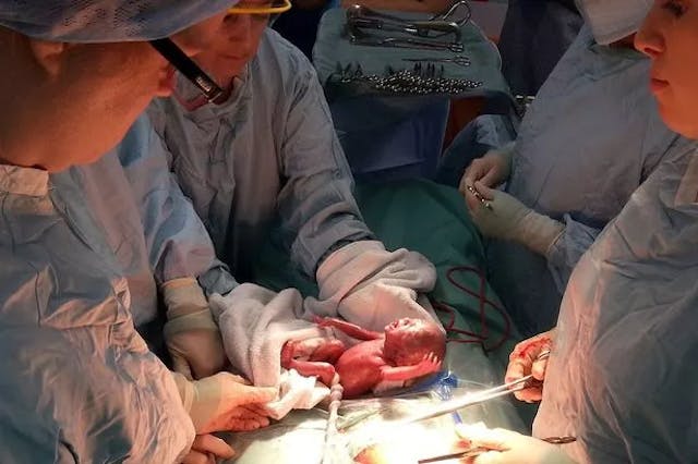 Baby Adelaide Caines at 24 weeks Emily Caines, who released a picture of a baby being born at 24 weeks (pictured) to highlight problems with the 24-week abortion limit says her broken heart has been fixed by the professor who enabled her to give birth to a healthy baby boy