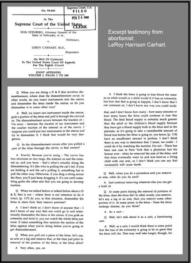 Abortionist’s testimony on dismemberment abortion (Dilation and Evacuation) or D+E described by abortionist LeRoy Carhart Image: D+E dismemberment abortion Dilation and Evacuation described by abortionist LeRoy Carhart