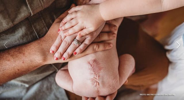 Photo: EBU Photography spina bifida