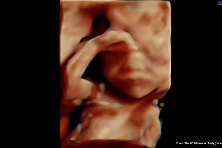 21 wks gestation – 4D Ultrasound Lady