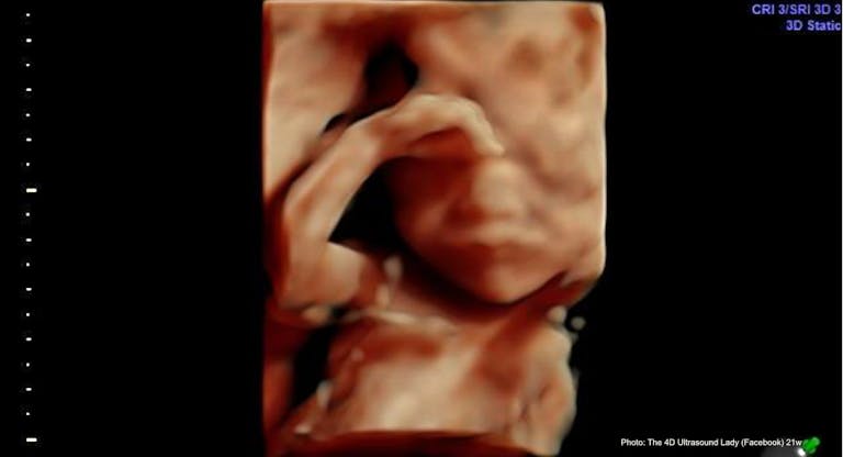 21 wks gestation – 4D Ultrasound Lady