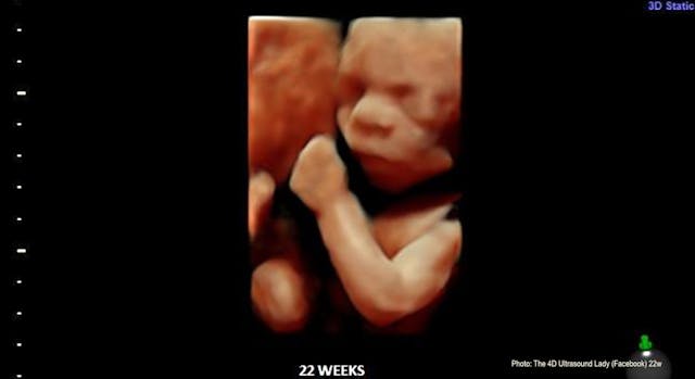 22 weeks gestation (4-D Ultrasound Lady) More babies born at 22 weeks are surviving, but it’s still legal to kill them image