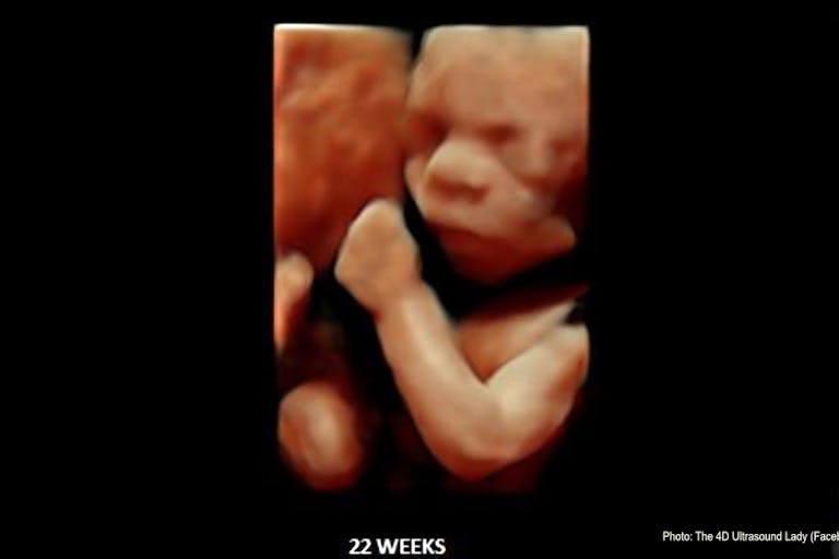 22 weeks gestation (4-D Ultrasound Lady) More babies born at 22 weeks are surviving, but it’s still legal to kill them image