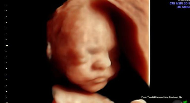 24 wks gestation – 4D Ultrasound Lady