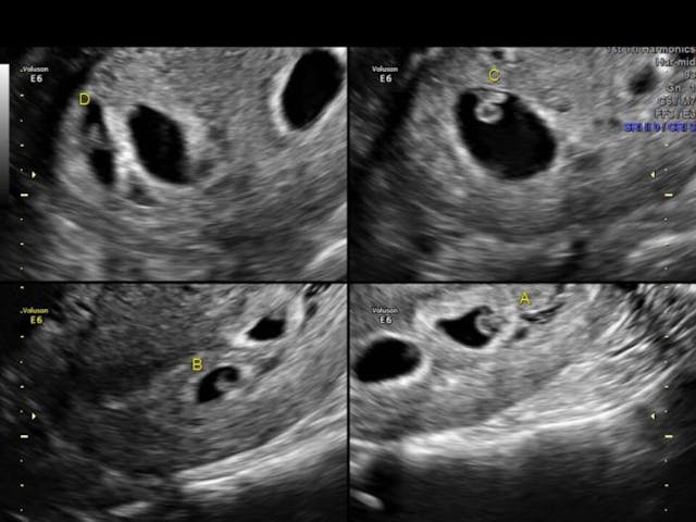 Born premature at 29 weeks, quadruplets show why every child deserves a chance image