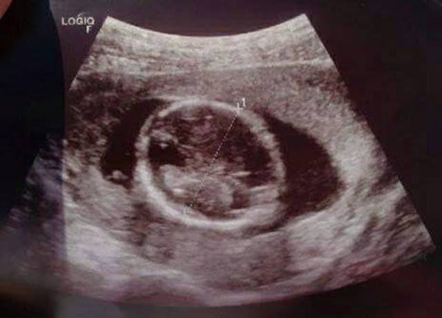 Planned Parenthood deceives woman considering abortion, breaks informed consent law image