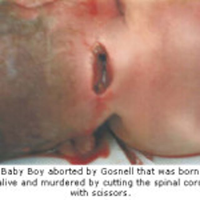 Are babies left to die when they survive abortion? image