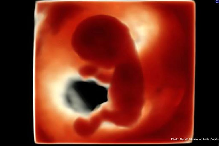 12 wks 4 days – 4D Ultrasound Lady