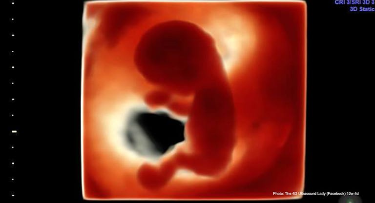 12 wks 4 days – 4D Ultrasound Lady