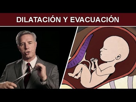 Aborto Quirúrgico en el Segundo Trimestre: Dilatación y Evacuación thumbnail