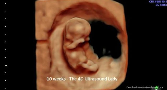 A so-called “bunch of cells” abortion pill reversal