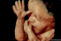 25 wks gestation – 4D Ultrasound Lady