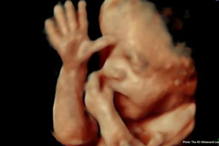 25 wks gestation – 4D Ultrasound Lady