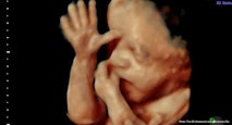 25 wks gestation – 4D Ultrasound Lady