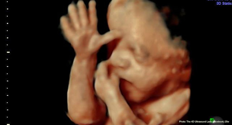 25 wks gestation – 4D Ultrasound Lady