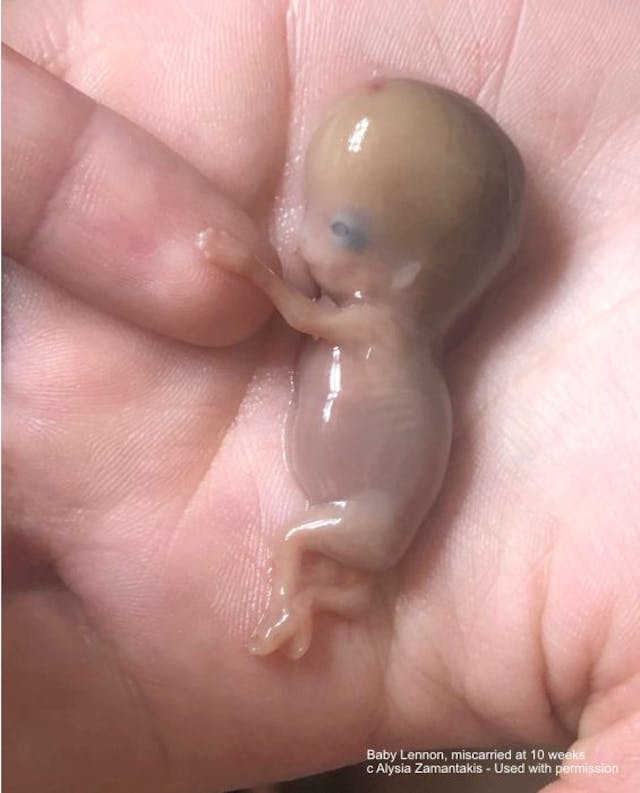 Baby Lennon, miscarried at 10 weeks (Photo: Alysia Zamantakis/Used with permission) EXCLUSIVE: Undercover video shows Virginia abortionist saying it’s ‘easy’ to dismember babies image