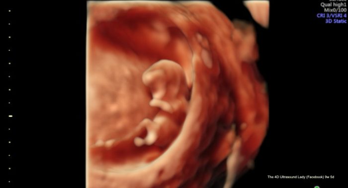 9 weeks 5 days gestation