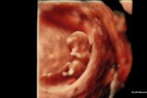 9 weeks 5 days gestation (4D Ultrasound Lady) 9 weeks 5 days gestation