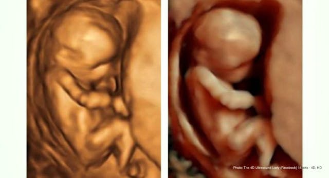14 weeks gestation, 4D/HD comparison (Photo: The 4D Ultrasound Lady – Facebook) Luxembourg Parliament discards mandatory abortion waiting periods image