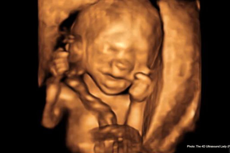 17 wks gestation – 4D Ultrasound Lady