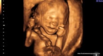 17 wks gestation – 4D Ultrasound Lady