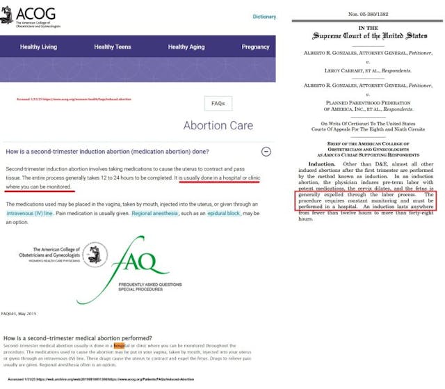 ACOG on induction abortion website (2011+2015) v amicus brief ACOG on induction abortion website (2011+2015) v amicus brief