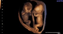 twins 1 – 4D Ultrasound Lady