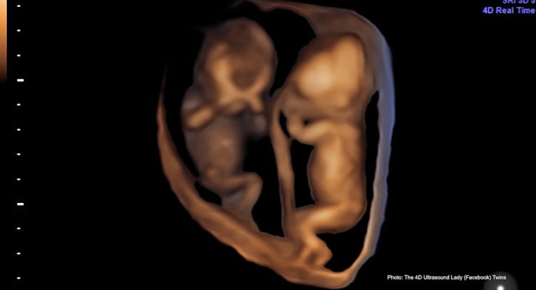 twins 1 – 4D Ultrasound Lady