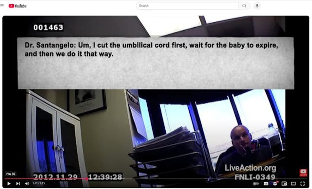 Santangelo late term abortionist cuts cord to kill baby umbilical cord transection Santangelo late term abortionist cuts cord to kill baby umbilical cord transection