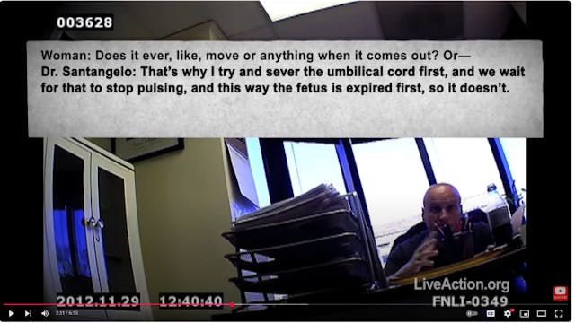 Late term abortionist described umbilical cord transection UCT in Live Action undercover video Late term abortionist described umbilical cord transection UCT in Live Action undercover video