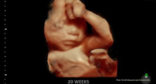 A preborn child at 20 weeks gestation (4D Ultrasound Lady – Facebook) Is it ‘cruel’ to protect a child from being killed for having a life-limiting diagnosis? image