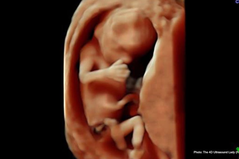 15 wks 4 days (2) – 4D Ultrasound Lady
