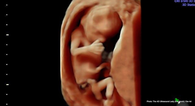 15 wks 4 days (2) – 4D Ultrasound Lady